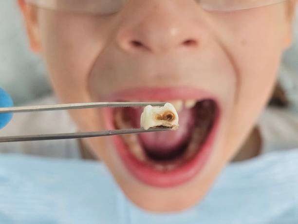 Best Emergency Dentist for Lost Fillings or Crowns in Salisbury, NY