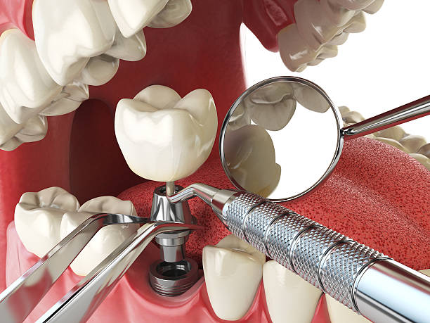 Best Emergency Dentist for Knocked-Out Tooth in Salisbury, NY